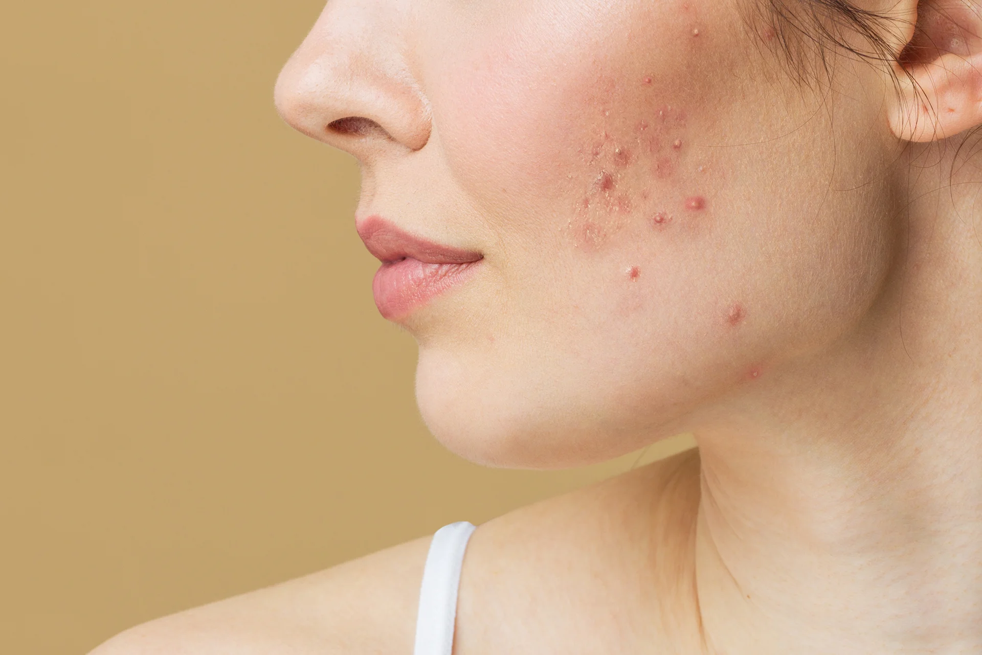 How to Treat Breakouts After Chemical Peel: A Comprehensive Guide