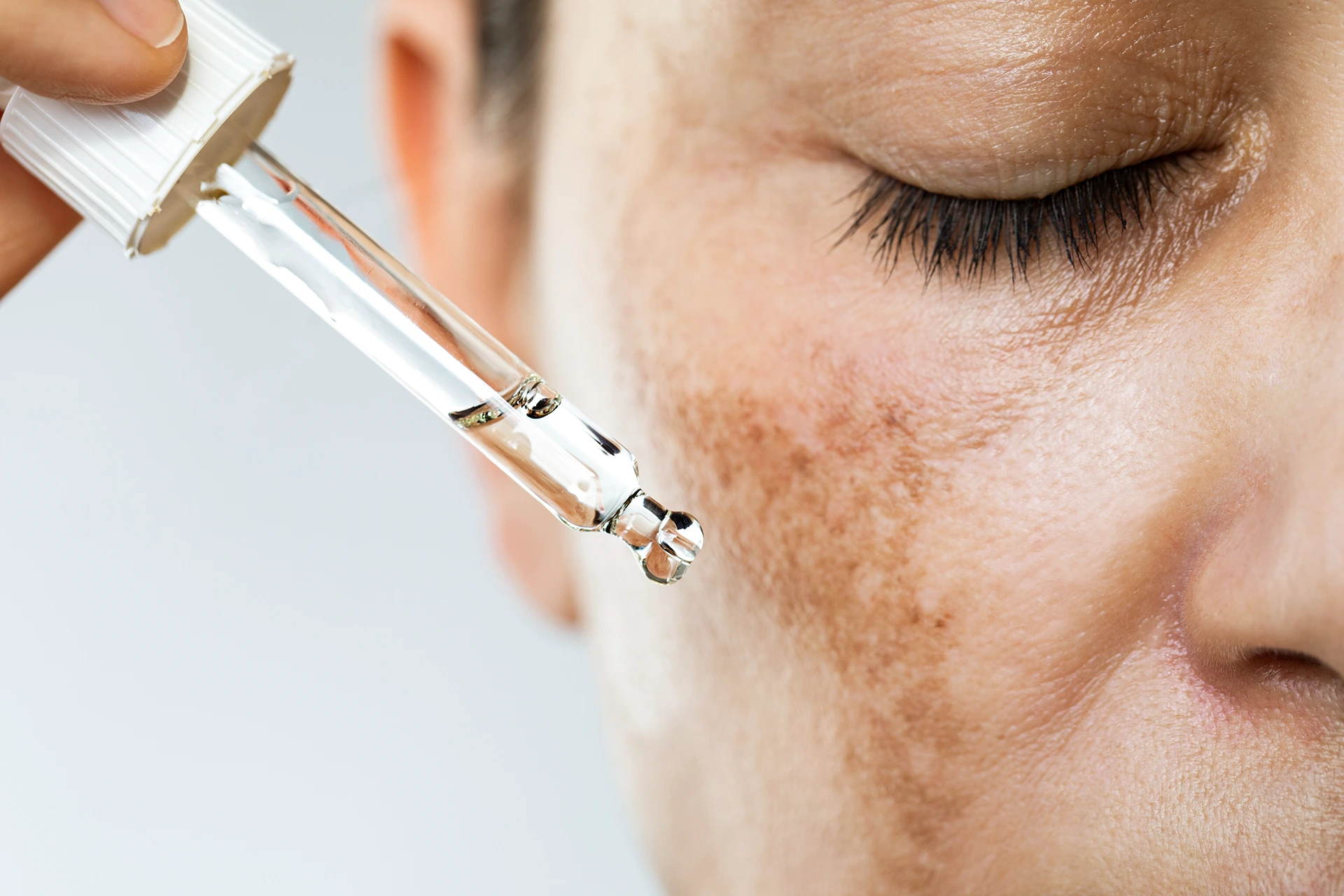 The Best Chemical Peels for Fading Dark Spots and Achieving an Even Complexion