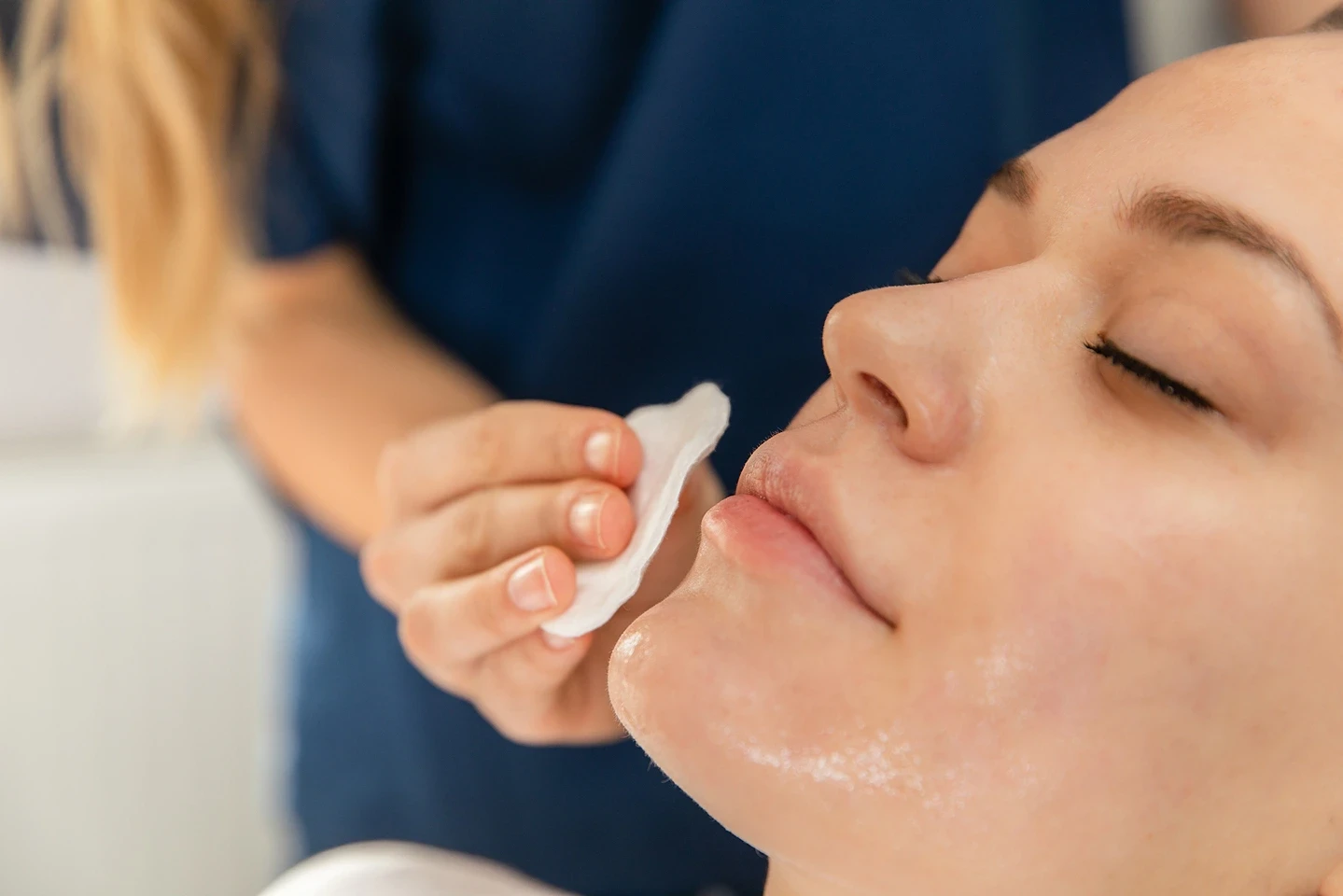 Do Chemical Peels Hurt?