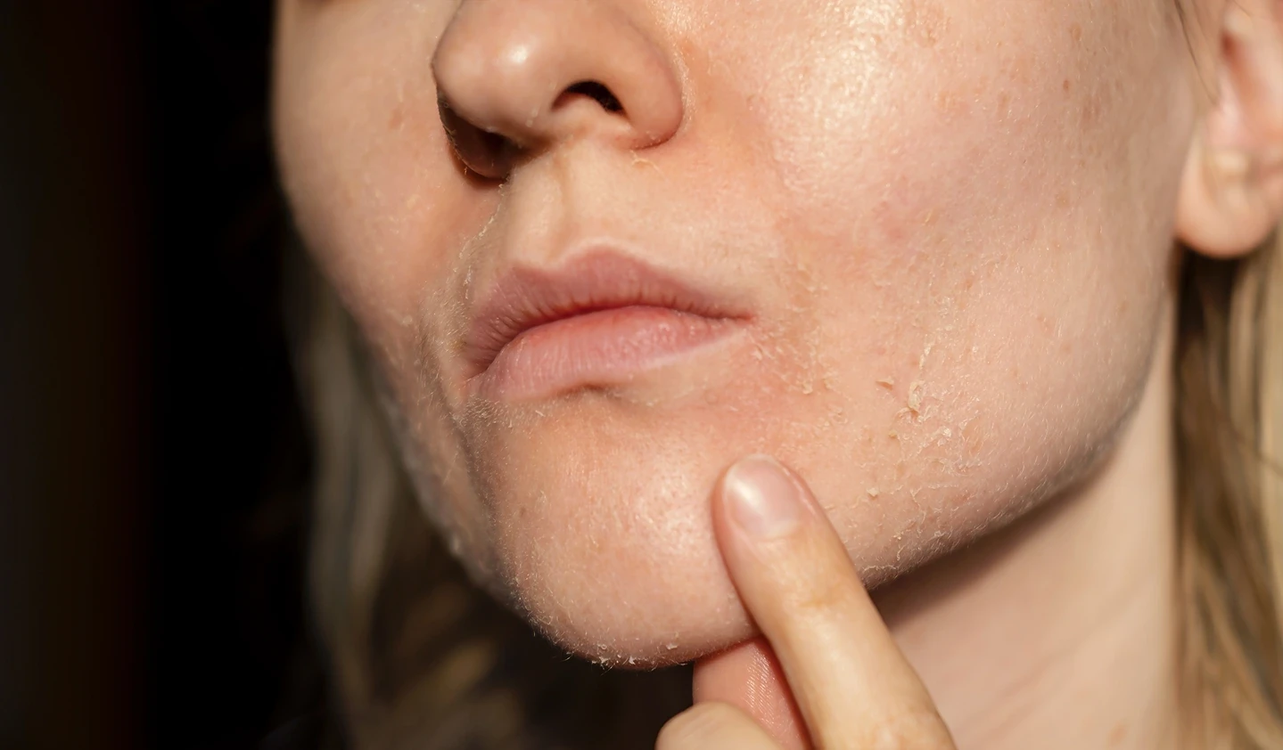 Face Itchy After Dermaplaning? Here’s Why