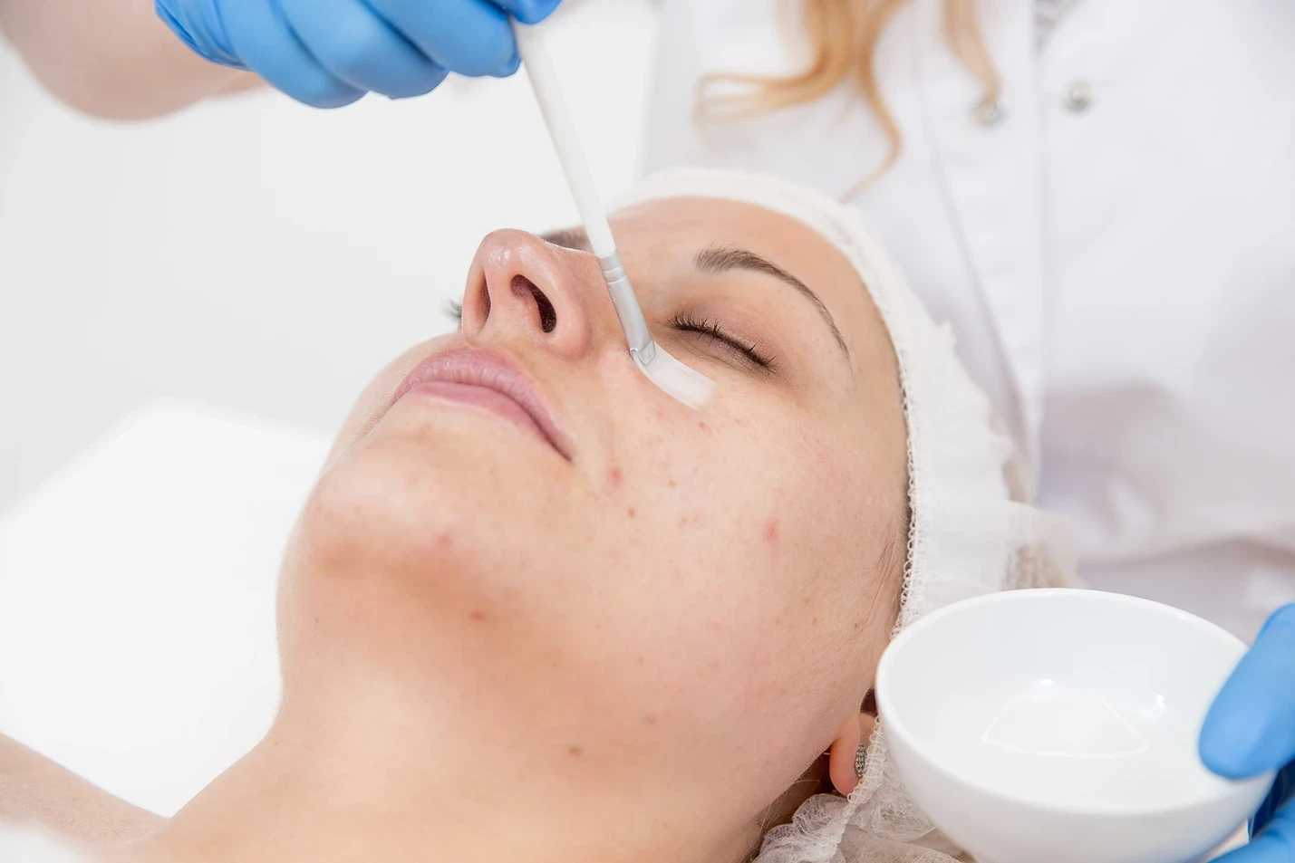 Can You Work Out After a Chemical Peel?