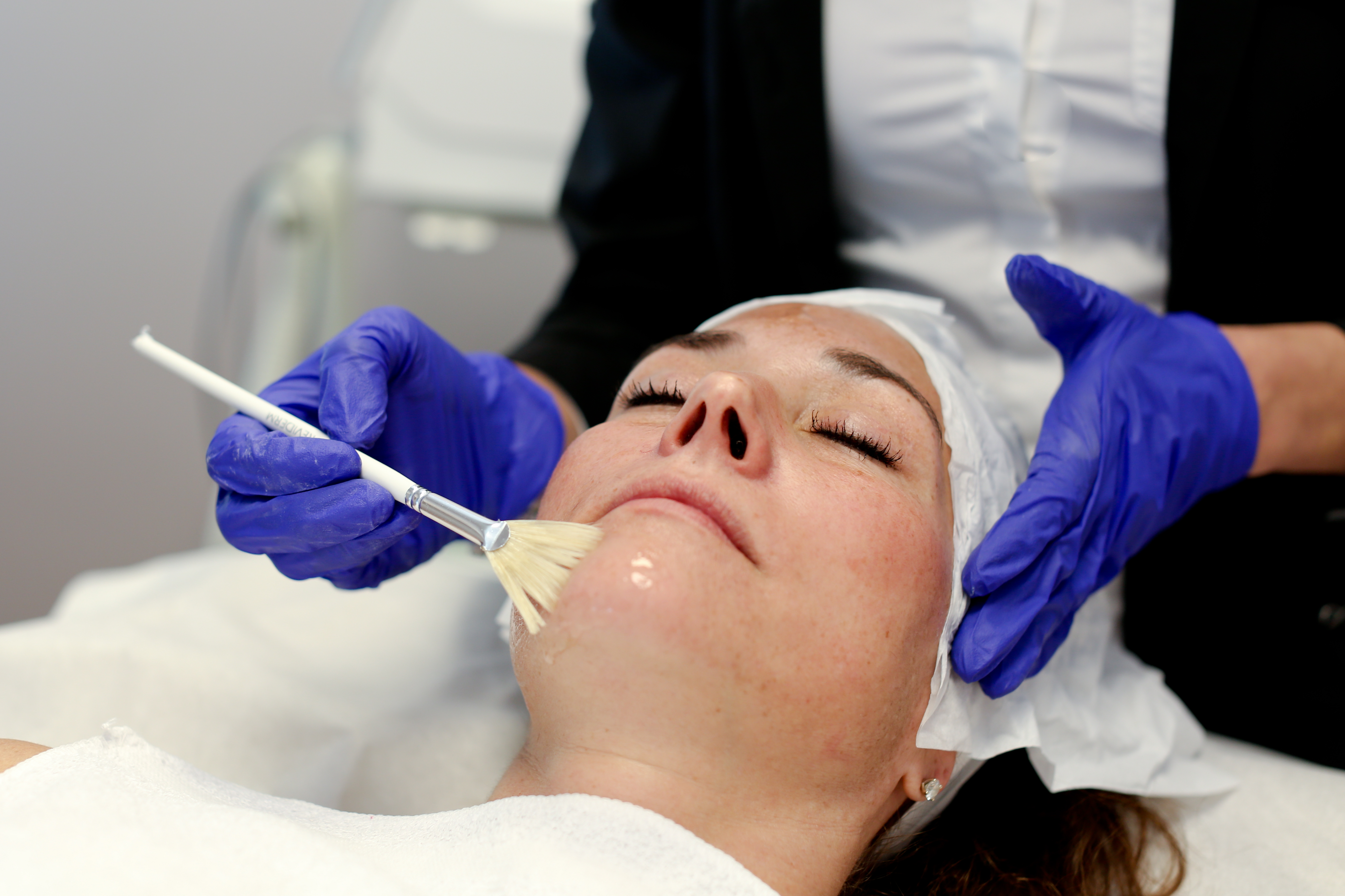 Chemical peel treatment at CosMedic LaserMD in Ann Arbor, MI