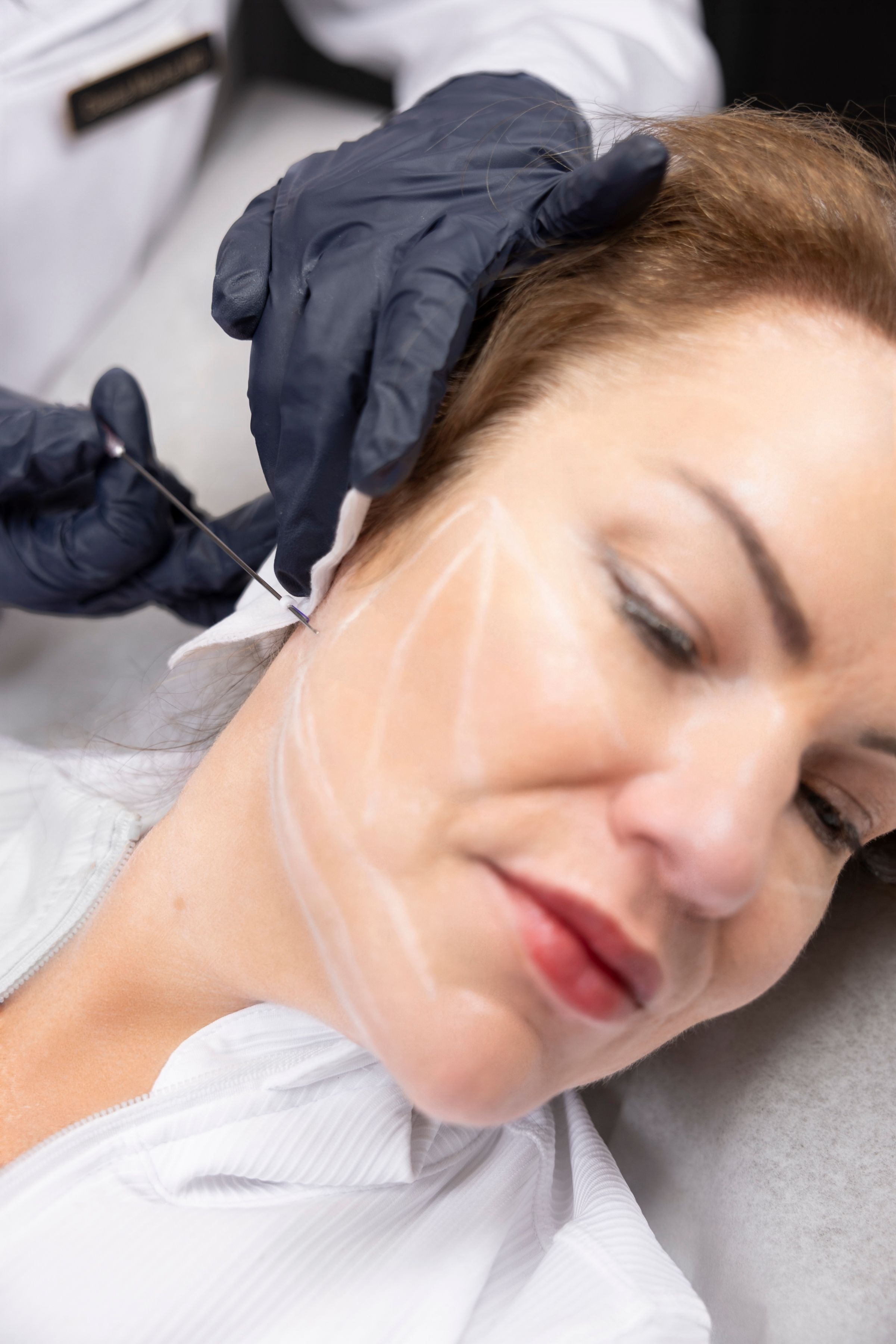 PDO thread lift at CosMedic LaserMD in Ann Arbor, MI